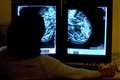 Women urged to attend breast screening to catch cancer early