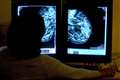Thousands ‘living with undiagnosed breast cancer’ as pandemic hits NHS screening