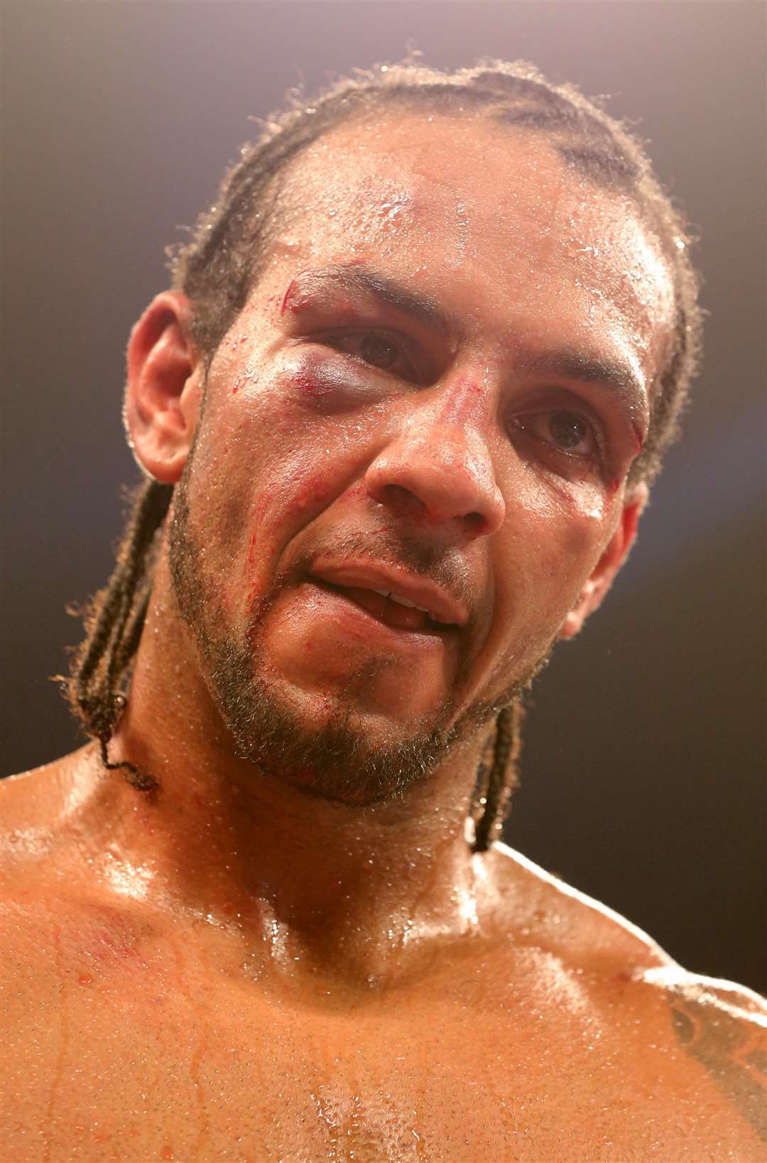 Wadi Camacho displays a black eye after losing to China Clarke during the Vacant English Cruiserweight Championship fight at Wembley Arena, London (PA)