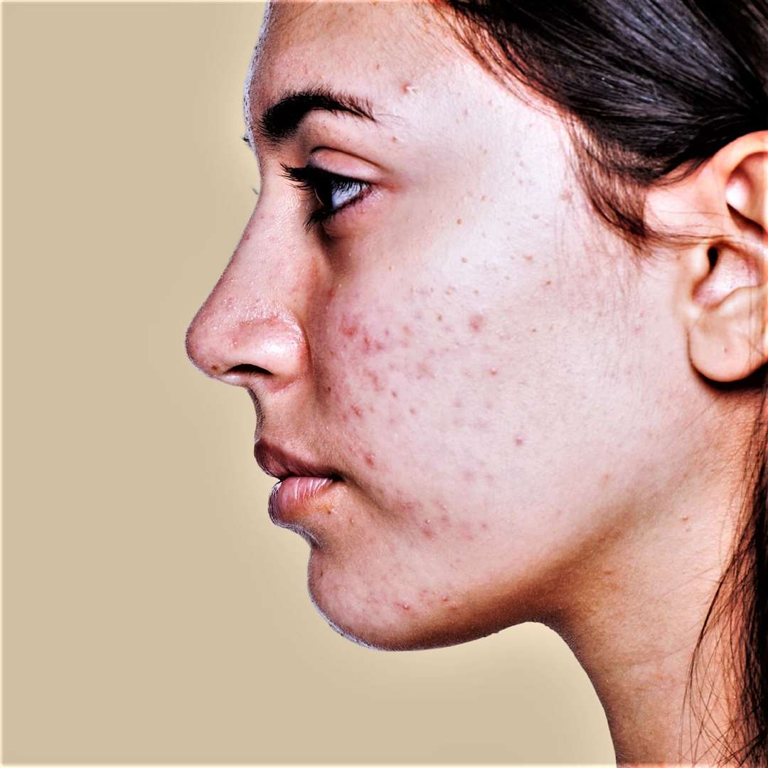 Acne can be exacerbated by wearing protective masks in a condition that is now called 'mascne'.