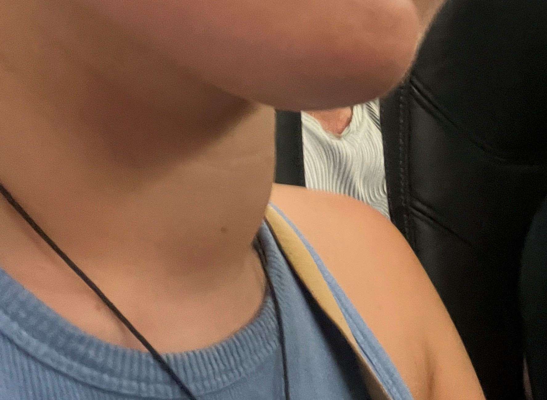 The lump on Megan Carr's throat was papillary thyroid cancer