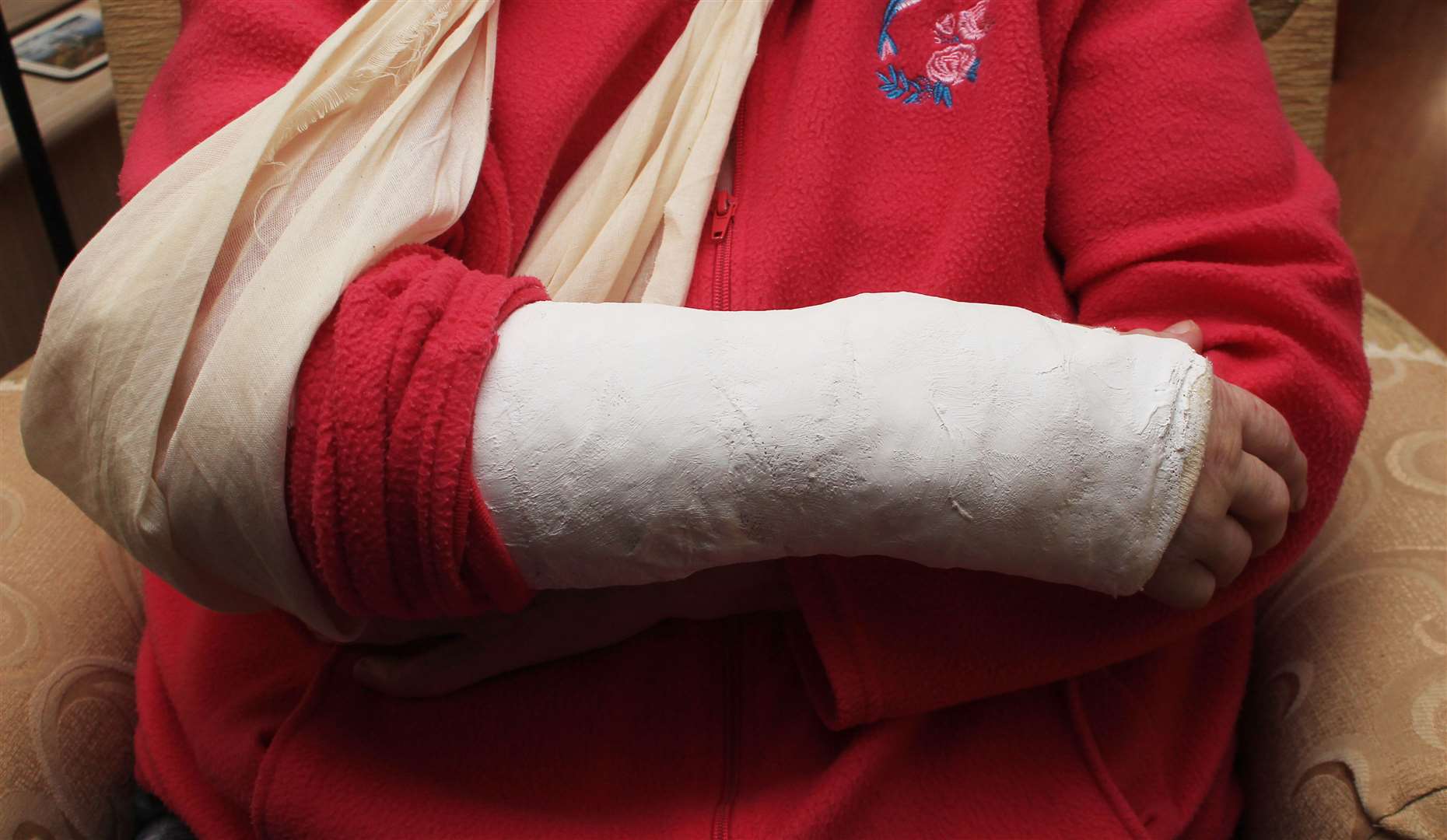 Mrs Sutherland's plaster cast.