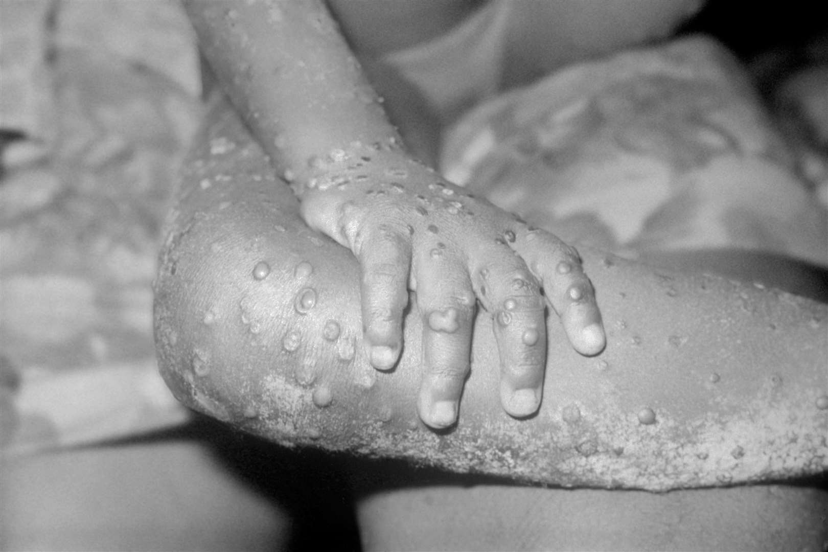 The most likely route of monkeypox transmission is close physical contact (Alamy/PA)