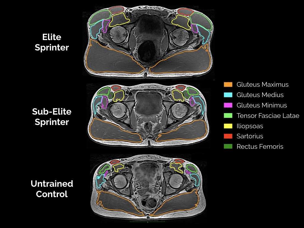 Hip muscle MRI example of three different individuals (Rob Miller/Loughborough University)